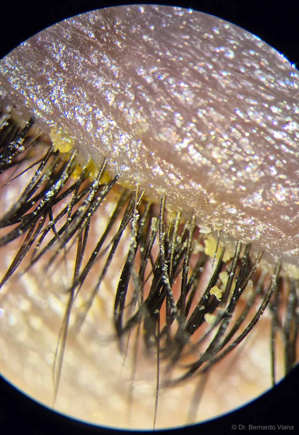 Blefarite anterior com colaretes — escamas cilíndricas de debris na base dos cílios, sinal característico de infestação por Demodex e inflamação crônica das glândulas de Meibômio