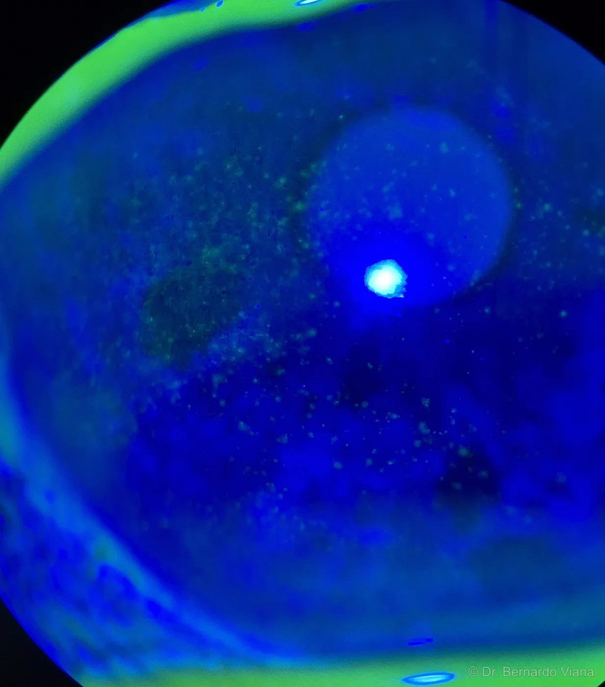Ceratite puntata superficial por olho seco — lesões da superfície da córnea evidenciadas por fluoresceína sob luz azul cobalto