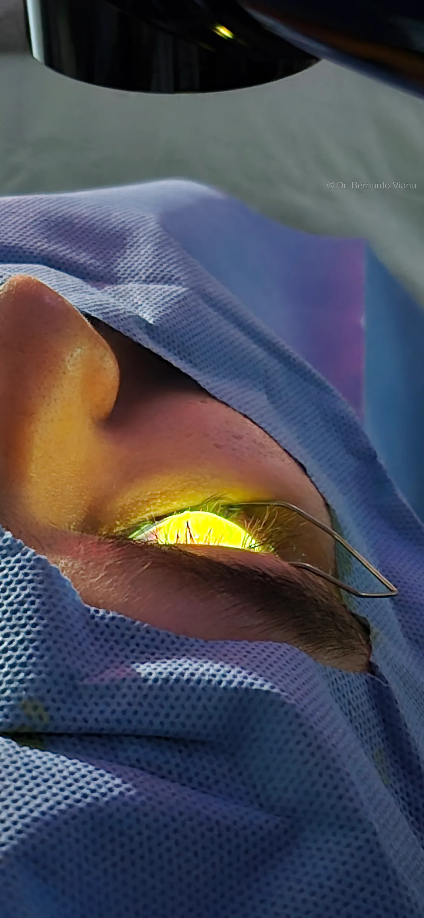 Dr. Bernardo Viana realizando crosslinking de córnea para tratamento de ceratocone