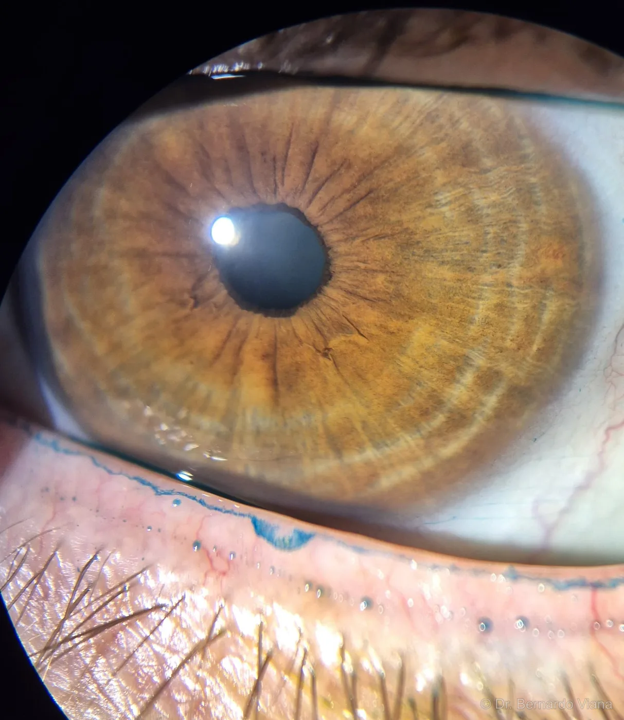 Margem palpebral inferior corada com lisamina verde — evidência de olho seco crônico com dano epitelial na borda palpebral